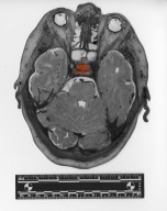 Slice of human skull and brain
