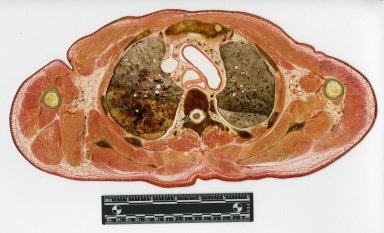 Cross section at superior lungs