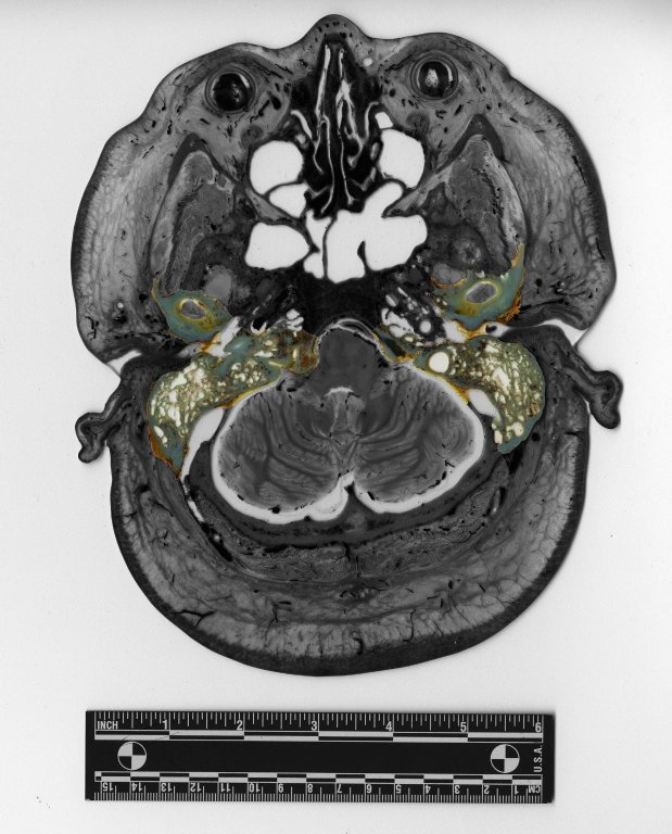 Cross section at head